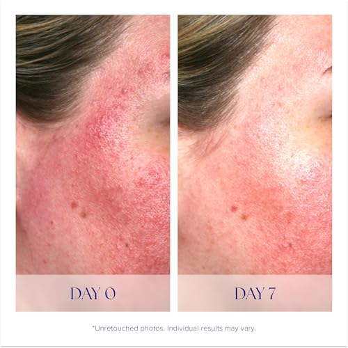iS Clinical Pro-Heal Serum: Vitamin-Enriched Antioxidant for Redness & Rosacea